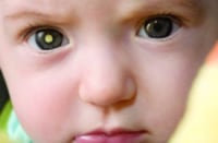 婴幼儿一侧瞳孔出现白色“光点”表明可能存在视网膜母细胞瘤